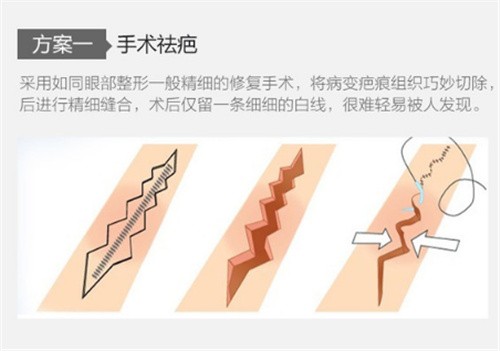 盘点常见的祛疤的方法有哪些？包含药物治疗/激光治疗/手术切除，不同情况适合方式不同