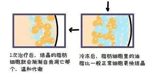 请查收！酷塑冷冻溶脂与吸脂哪个好？从吸脂原理/可靠性/成效/适用人群/恢复期多方面进行对比