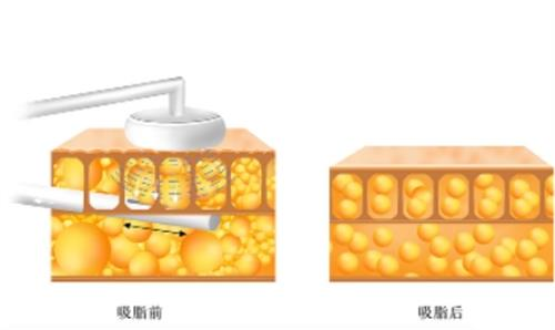 请问：吸脂医生如何选？要从医生的学历资质/职称经验/学术成就/技术水平/服务态度等进行多方面考虑