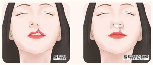 成都刘玉辉做嘴巴咋样？患者直呼：M唇、嘴角上扬、兔唇修复等老牌唇部整形医生的非凡技艺