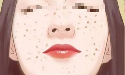 超皮秒祛斑真的有用吗？有用主要适用于色斑困扰者