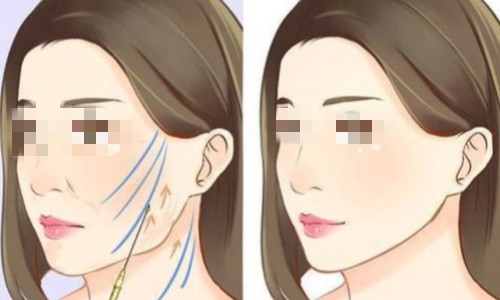 两大抗衰技术：筋膜提升与埋线提升有什么区别？哪种更适合我？