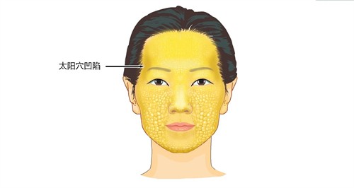 太阳穴凹陷怎么样才能变得圆润？注射玻尿酸|磨骨|截骨等都能改善颞部凹陷问题