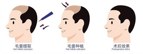 北京首瑞植发医院正规吗？医生团队与医院资质全方面审核通过，植发失活率不高