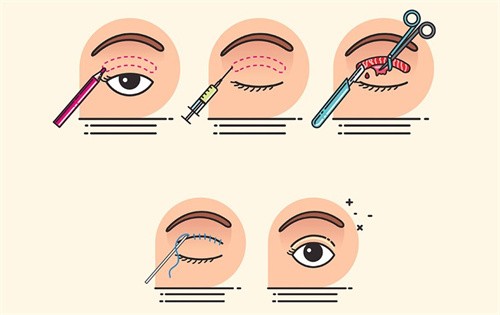 湛江做埋线双眼皮有名的医院名单：含韩美整形|华美医美|韩逅整形|名媛整形|康特美整形审美优势