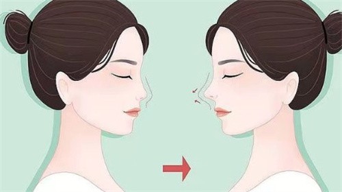 赛格尔马隆鼻修复怎么样？野生患者实例漂亮，马强|兰淑华医生隆鼻修复技术揭秘！