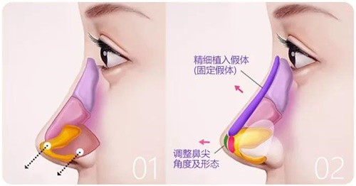 官方直出！简阳直客医美地址+收费表分享：生态自然鼻3000+180美眼1w+幼态脸2.98w+