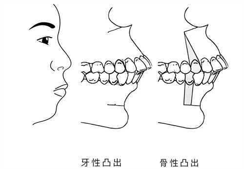 广州正颌手术有名的医生名单大汇总，内有2025广州做正颌手术价目表分享
