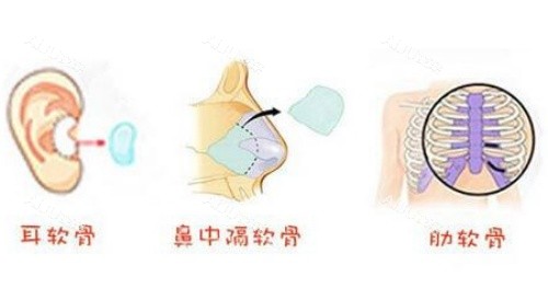 自身软骨组织漫画结构图