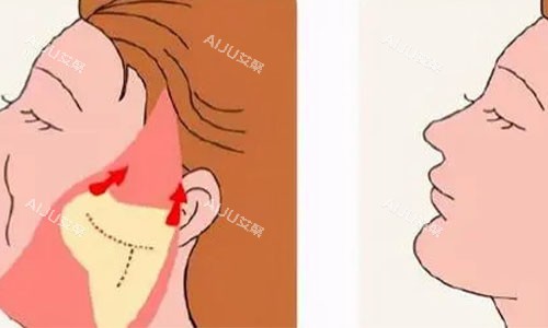 真实分享！做北京做拉皮手术好的医生：杜太超|隋冰|李晓东等技术口碑好