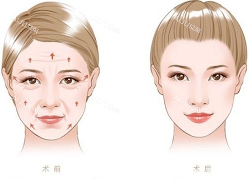 筋膜悬吊和筋膜提升一样吗