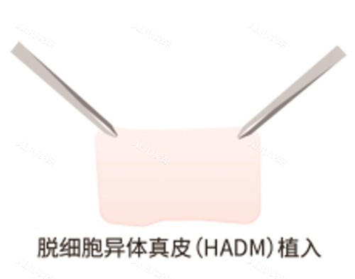 男性私密增粗手术价格