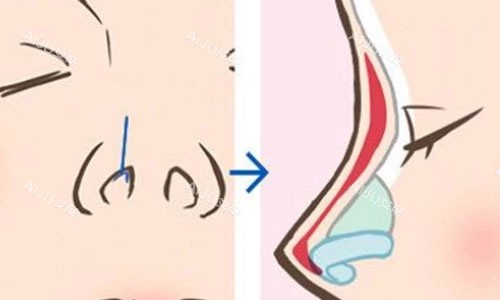 隆鼻示意图