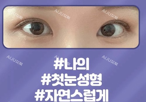 韩国爱护整形医院眼部整形
