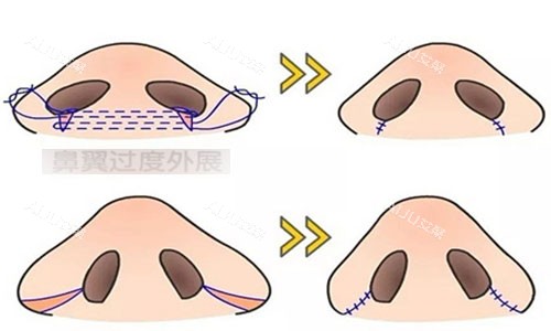 鼻翼缩小手术示意图