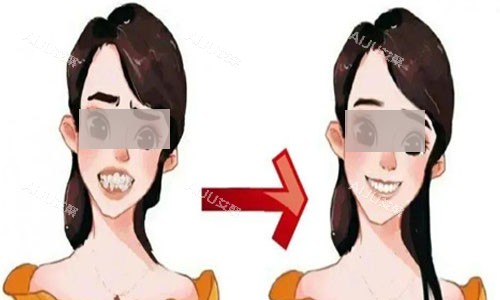 牙齿矫正变化