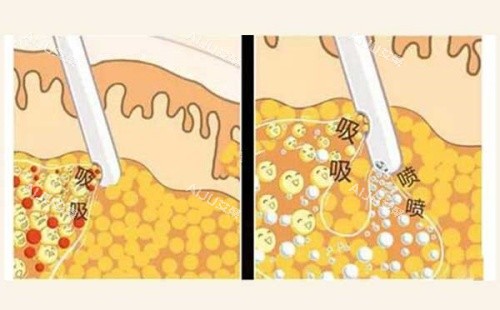 吸脂操作示意图