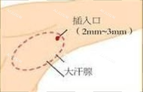 手术去除狐臭的切口部位