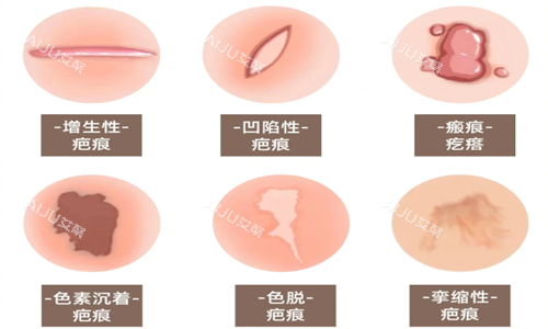 常见的疤痕种类