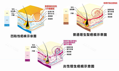 疤痕增生示意图