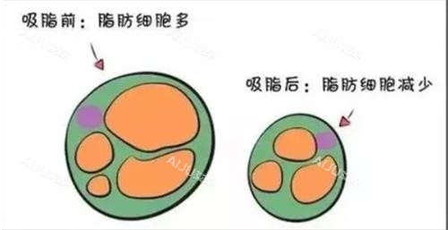 吸脂前后动画图示