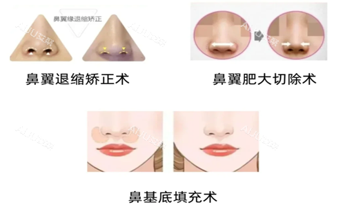 鼻综合手术类别