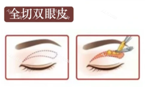 全切双眼皮