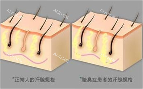 狐臭人群和正常人群汗腺对比动画展示
