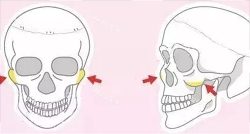 磨骨手术之颧骨手术展示图