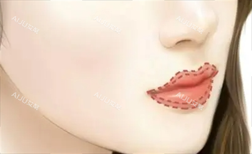 丰唇唇部画线填充图