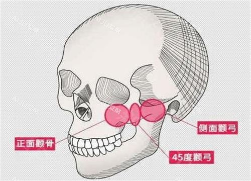 颧骨整形手术示意图