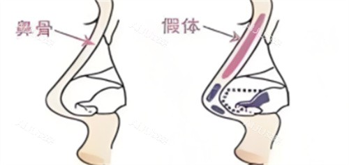 放眼看!2024沈阳地区鼻部整形价格在线查:隆鼻4800+|鼻综合5800+自体骨隆鼻9800+