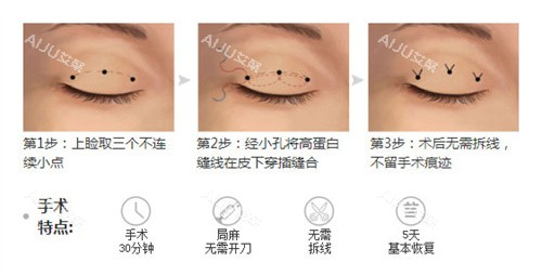 双眼皮三点术过程特点