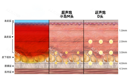 热玛吉作用示意图