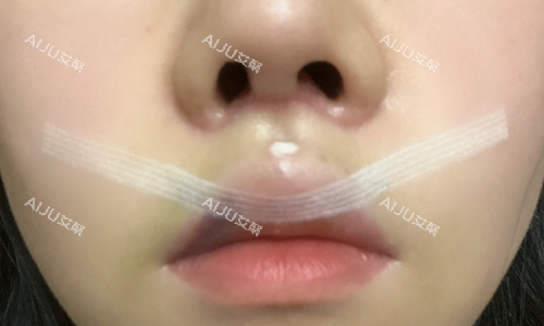 不开刀人中缩短手术示意图