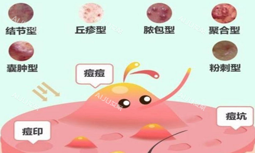 痘坑痘印示意图