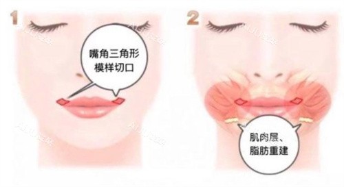 微笑唇手术