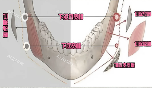 V-LINE瓜子脸手术示意图