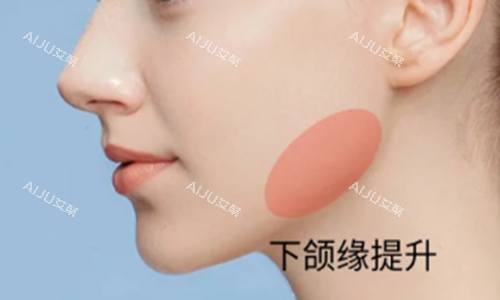下颌缘提升示意图
