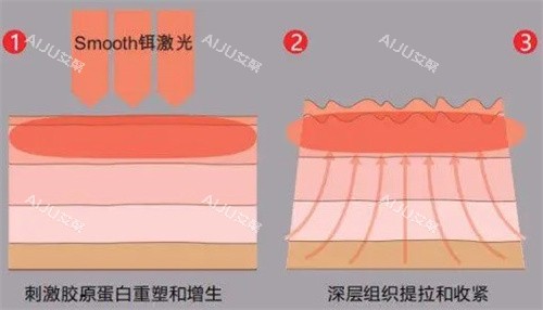 v8艾拉蛋白线有效多长时间?2-5年之久,持久结果与提升成效的深度解析