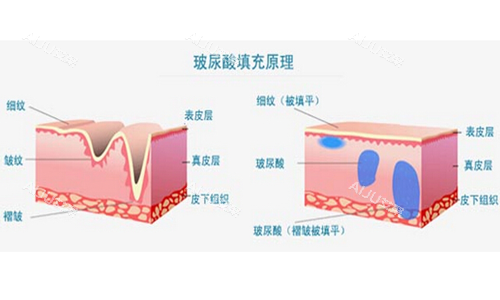 玻尿酸填充作用示意图
