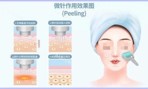 微针治疗