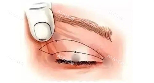 提眉点位眼部标识图