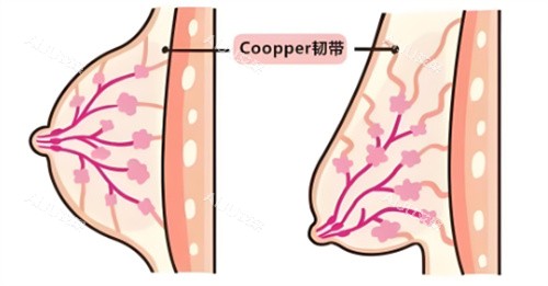 胸部下垂矫正手术的方法有哪些？含双环法/垂直切口/倒T切口等术式优势解答