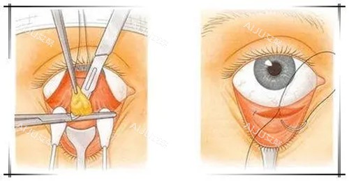 内切法祛眼袋卡通示意图 内切法祛眼袋卡通示意图