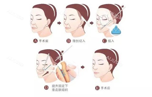 安多泰拉皮手术
