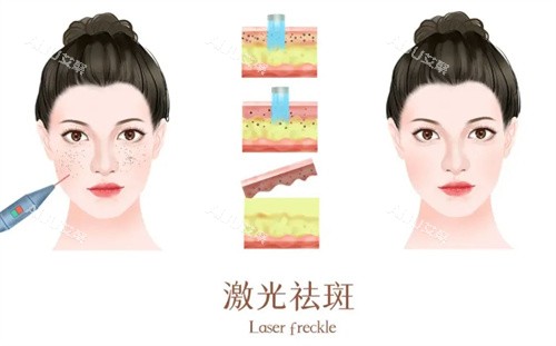 在正规医院做激光祛斑手术得多少钱？一般基础去斑1000+/皮秒激光祛斑2800+/黄褐斑3500+