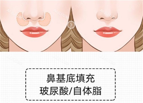 鼻基底填充前后对比图