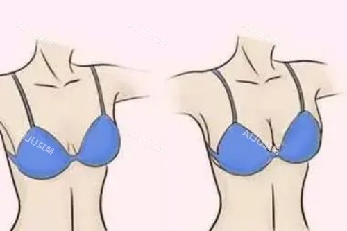 长春奥拉克整形假体丰胸卡通对比图