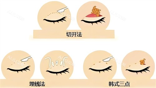 长春奥拉克整形双眼皮方法对比图